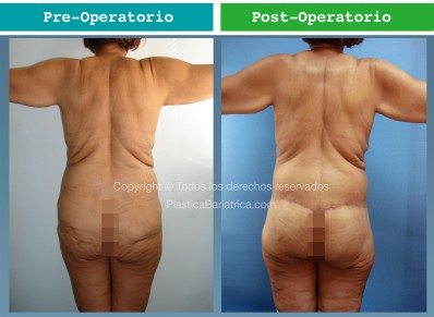 Dermolipectomia Circunferencial