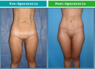 Dermolipectomia Horizontal