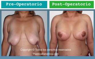 Mamoplastia 3