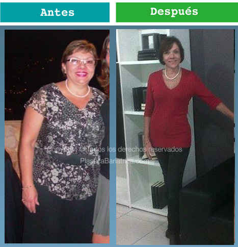 Pre y Post Sra Buscarini