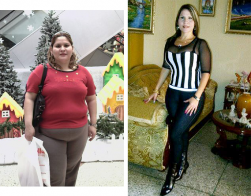 Antes y despues Plasticabariatrica