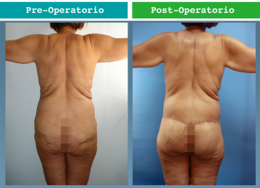 Dermolipectomia Circunferencial